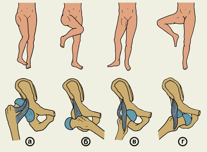 Рис. 2. Порочные положения нижней конечности при различных видах травматических вывихов левого бедра и схемы смещений головки бедренной кости: а — задневерхний вывих; б — задненижний вывих; в — передневерхний вывих; г — передненижний вывих
