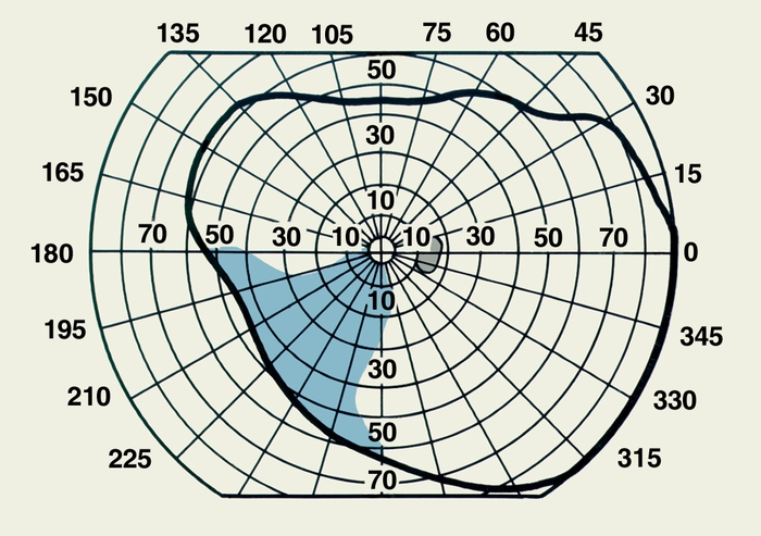Рис. 2б). Схема поля зрения, полученная при периметрии левого глаза с использованием белого тест-объекта (выпавшие участки обозначены голубым цветом): при далеко зашедшей глаукоме (секторообразное <a href=