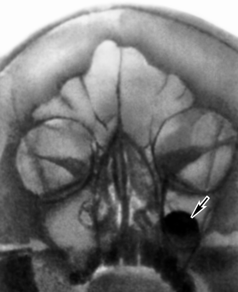 Рис. 5. Рентгенограмма черепа и придаточных пазух носа при кисте левой верхнечелюстной пазухи (носоподбородочная проекция): в нижнем отделе пазухи определяется тень кисты (указана стрелкой)