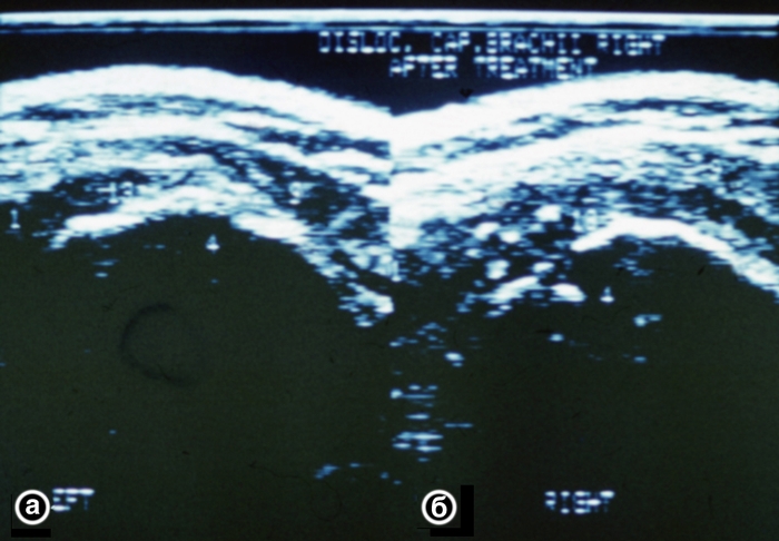 Рис. 19. Ультрасонограммы плечевых суставов (<a href=