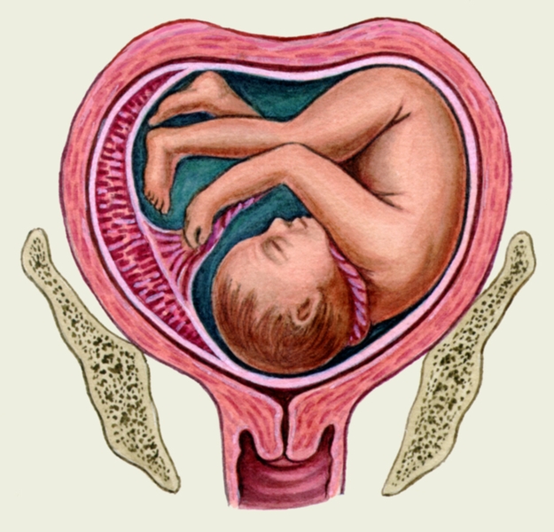 Рис. 5б). Схематическое изображение плода в матке при седловидной матке
