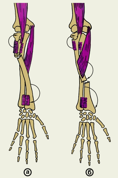 Рис. 4. Схема смещения отломков при переломе лучевой кости выше (а) и ниже (б) места прикрепления круглого пронатора: направление смещения указано стрелками