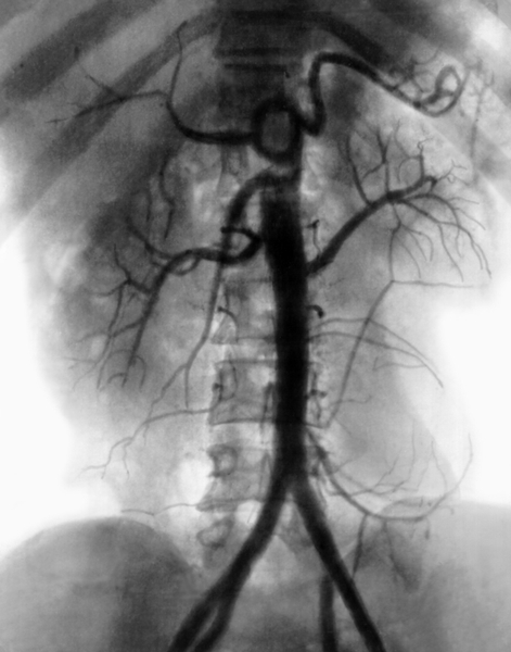 Рис. 6. Брюшная аортограмма при опухоли забрюшинного пространства: <a href=
