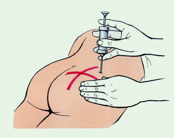 Рис. 4. Внутримышечная инъекция в ягодичную область