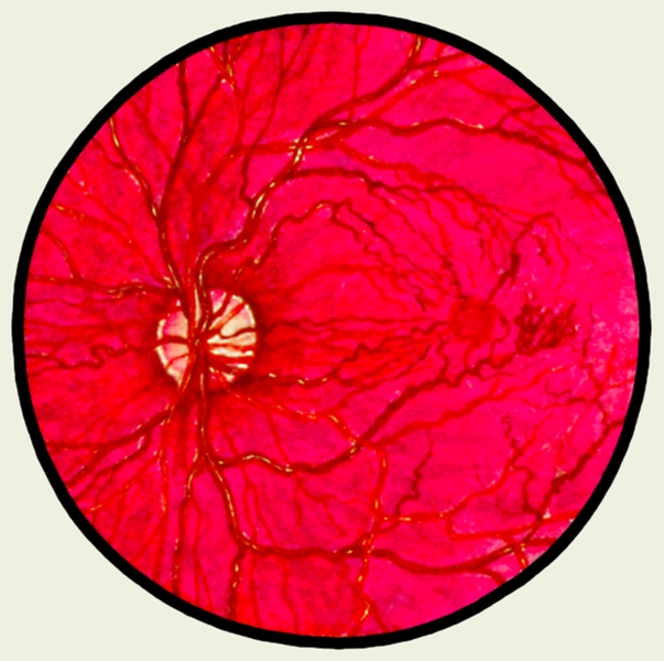 Рис. 13. Глазное дно в норме и при патологии. Диабетическая ангиоретинопатия: артерии сетчатки сужены, вены расширены, сосуды неравномерного калибра; вокруг желтого пятна микроаневризмы и мелкие очаговые кровоизлияния; много новообразованных сосудов