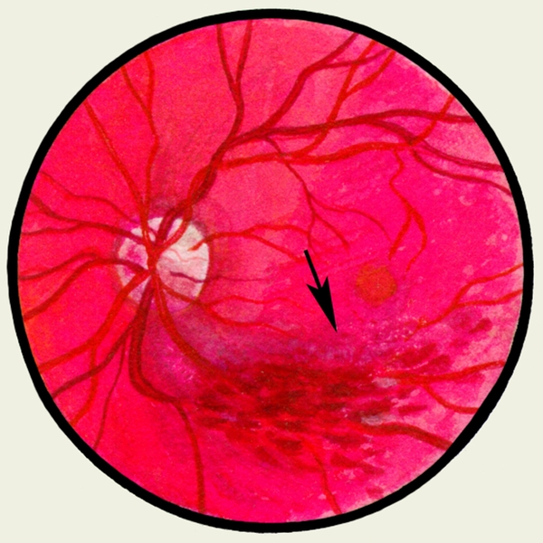 Рис. 5. Глазное дно в норме и при патологии. Непроходимость ветви центральной вены сетчатки: стрелкой указано <a href=