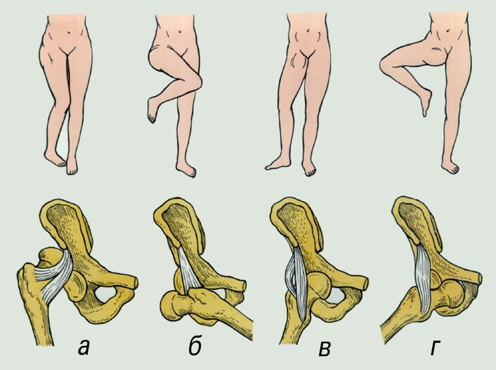 Рис. Вынужденные (порочные) положения нижней конечности при различных видах травматических вывихов правого бедра (верхний ряд) и схемы смещения головки бедренной кости (нижний ряд): а — задневерхний вывих; б — задненижний вывих; в — передневерхний вывих; г — передненижний вывих