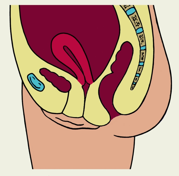 Рис. 5б). Схематическое изображение некоторых аномалий положения матки на сагиттальном разрезе малого таза — смещение матки кпереди по отношению к геометрическому центру малого таза (антепозиция)