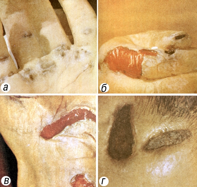 Рис. 1. Электроожоги кожи различной степени: а — множественные электроожоги II—III стерени на ладонной поверхности кисти и пальцев в виде участков неправильной формы сероватого оттенка с признаками так называемой металлизации (пострадавший взял в руку провод, находящийся под напряжением 220 В); б, в — электроожоги III степени тыльной поверхности II пальца (б) и предплечья (в) после отторжения омертвевшей ткани; г — электроожог IV степени на коже головы