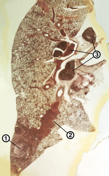 Рис. 1. Гистотопографический срез легкого и внутригрудных лимфатических узлов при первичном туберкулезном комплексе: 1 — первичный аффект в легком; 2 — лимфангиит; 3 — бронхаденит; окраска гематоксилином и эозином