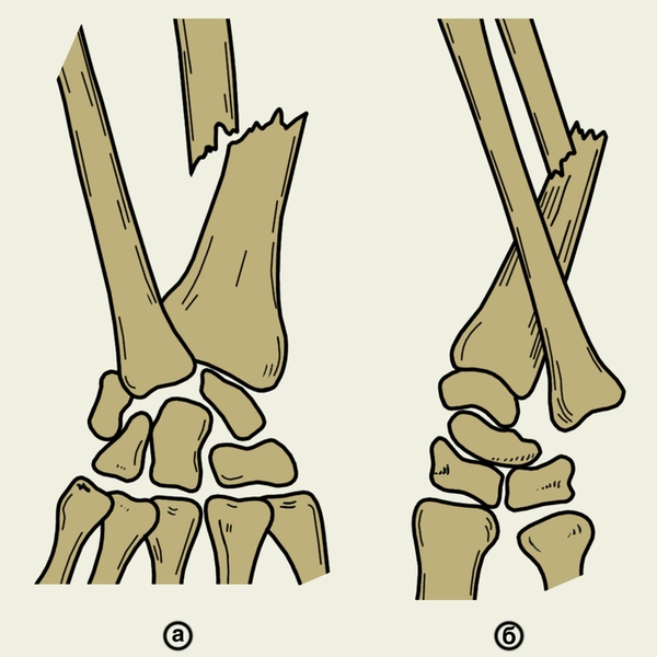Рис. 5. Схемы части предплечья и кисти при переломовывихе Галеацци (а — прямая проекция, б — боковая проекция): виден перелом лучевой кости со смещением головки локтевой кости