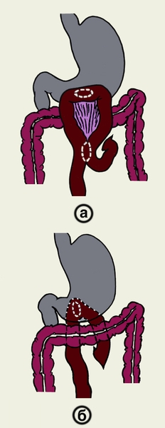 Рис. 6. Схематическое изображение гастроэнтеростомии: а — по Вельфлеру; б — по Гаккеру