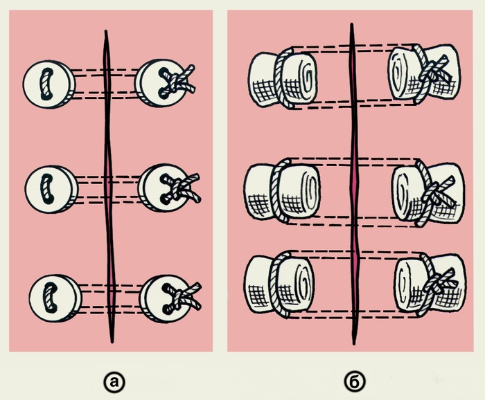 Рис. 11. Схематическое изображение пластинчатых П-образных швов: а — на пуговицах; б — на марлевых шариках