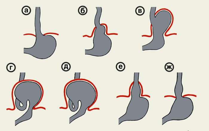 Рис. 4. Схематическое изображение различных видов скользящих хиатальных грыж: а — пищеводная; б — кардиальная; в — фундальная; г — субтотальная; д — тотальная; е — приобретенный короткий пищевод; ж — врожденный короткий пищевод