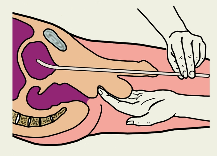 Рис. 3в). Схематическое изображение некоторых последовательных этапов катетеризации мочевого пузыря металлическим катетером у мужчин: третий этап — катетер отклоняют книзу и, придерживая его через <a href=