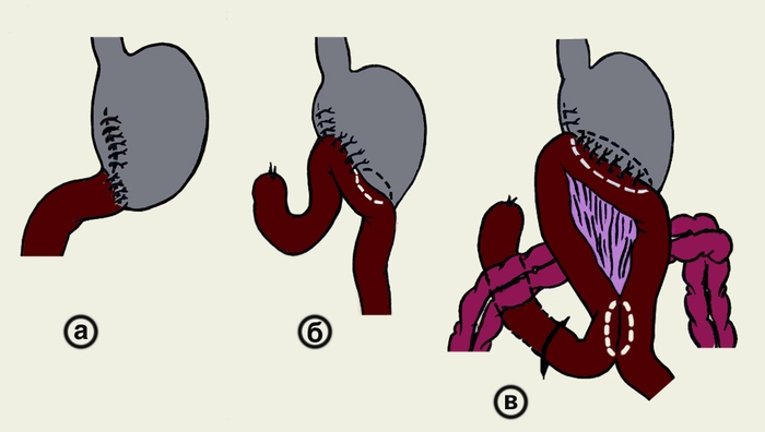 Рис. 8. Схематическое изображение дистальной резекции желудка: а — способ Бильрот-I; б — способ Бильрот-II в модификации Гофмейстера — Финстерера; в — способ Бильрот-II в модификации Бальфура