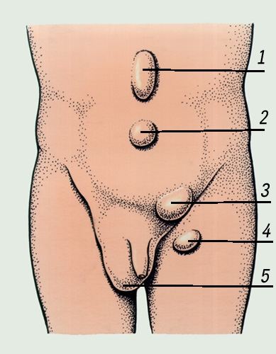 Рис. 1. Схема расположения наиболее часто встречающихся наружных грыж живота: 1 — грыжа белой линии живота; 2 — пупочная грыжа; 3 — паховая грыжа; 4 — бедренная грыжа; 5 — пахово-мошоночная грыжа