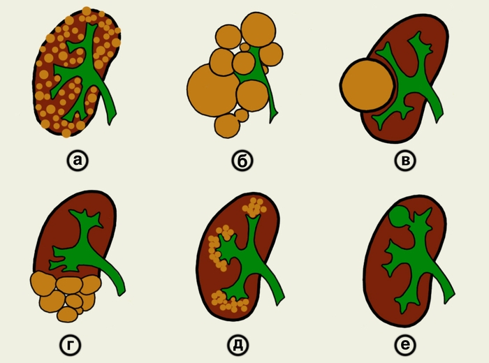 Рис. 6. Схематическое изображение различных видов кистозных аномалий почек (зеленым цветом показана чашечно-лоханочная <a href=