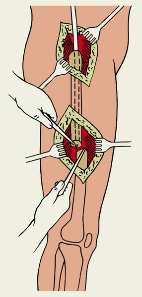 Рис. 3б). Открытый внутрикостный остеосинтез бедра: штифт введен ретроградно в центральный отломок
