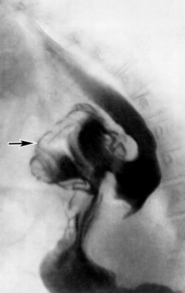 Рис. в). Рентгенологическая картина при различных заболеваниях и поражениях пищевода, сопровождающихся дисфагией: грыжа пищеводного отверстия диафрагмы (указана стрелкой)