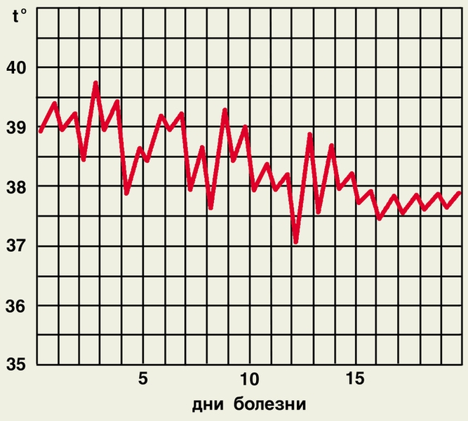 Рис. 2ж). Температурные кривые при различных типах лихорадки — неправильная