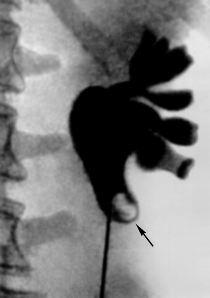 Рис. 2. Рентгенограмма левой почки при почечно-каменной болезни: почечные чашечки и лоханки расширены, в лоханочно-мочеточниковом сегменте виден <a href=