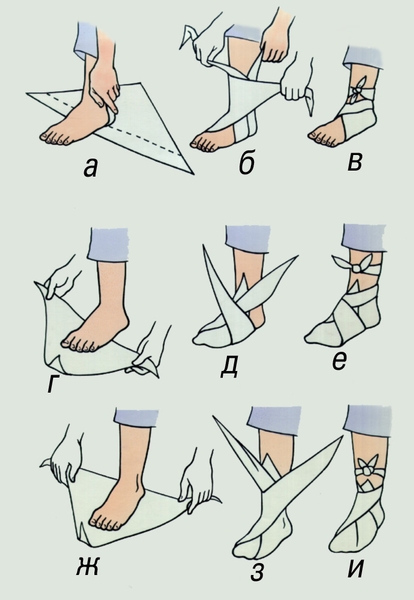 Рис. 2. Наложение косыночной повязки на пятку (а, б, в), на пальцы и передний отдел стопы (г, д, е), на всю стопу (ж, з, и)