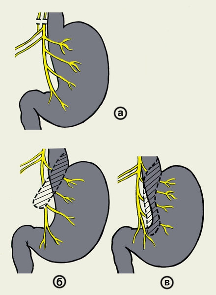 Рис. 11. Схематическое изображение ваготомии: а — стволовой; б — селективной желудочной; в — селективной проксимальной