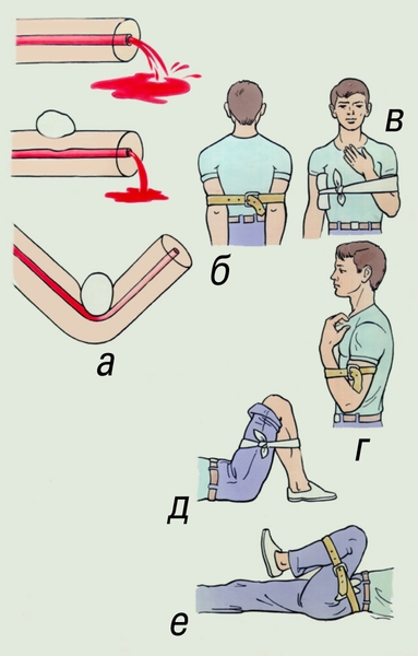 Рис. 4. Методы остановки кровотечения из сосудов конечностей путем их форсированного сгибания: а — общий механизм действия форсированного сгибания конечности (1 — кровеносный сосуд, 2 — валик, 3 — конечность); б — при ранении подключичной артерии; в — при ранении подмышечной артерии; г — при ранении плечевой и локтевой артерий; д — при ранении подколенной артерии; е — при ранении бедренной артерии