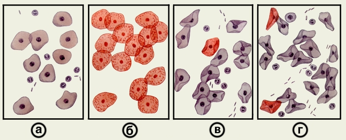 Рис. 2. Микроскопические картины влагалищных мазков при нормальном менструальном цикле: а — в раннюю фолликулярную фазу (до 9-го дня менструального цикла); б — во время овуляции (14-й день менструального цикла); в — в начале лютеиновой фазы (15-20-й дни менструального цикла); г — в позднюю лютеиновую фазу (24-28-й дни менструального цикла)