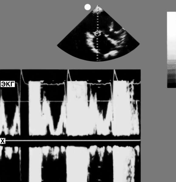 Рис. 16. Допплер-эхокардиограмма потоков крови в полости левого предсердия (проекция локации показана вверху на двухмерной эхокардиограмме) вблизи створок митрального клапана при его недостаточности: на спектрограмме в диастолу (периоды систолы и диастолы легко определяются по зарегистрированной над спектрограммой ЗКГ) эхосигналы соответствуют ламинарному, т.е. нормальному, потоку крови через атриовентрикулярное отверстие (границы незаштрихованного 