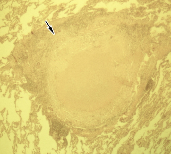 Рис. 7. Микропрепарат легкого при очаговом туберкулезе: в легочной ткани определяется отграниченный очаг казеозного некроза с перифокальной продуктивной реакцией (указан стрелкой); окраска гематоксилином и эозином; ×8