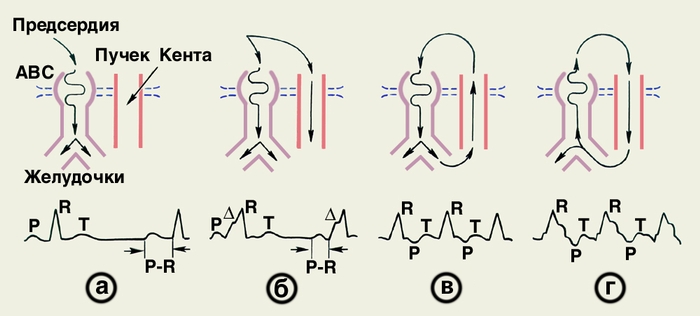 Вверху — схема разных вариантов проведения импульса возбуждения между предсердиями и желудочками по атриовентрикулярному соединению (АВС, сиреневые контуры) и пучку Кента (п.К., красные контуры), в норме (а) и при синдроме Вольфа — Паркинсона — Уайта (б, в, г); внизу — их отображение на электрокардиограммах: а — проведение только по АВС, нормальная ЭКГ; б — проведение по пучку Кента, опережающее возбуждение желудочков от импульса из АВС, на ЭКГ — укорочение интервала Р—R и расширение желудочкового комплекса за счет волны ∆; в, г — реципрокная тахикардия при ортодромной (в) и антидромной (г) циркуляции возбуждения в путях АВС м пучка Кента, на ЭКГ — инвертированные зубцы Р, следующие за желудочковыми комплексами, последние при антидромной циркуляции возбуждения значительно расширены