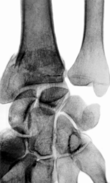 Рис. 14а). Рентгенограмма части предплечья и кисти при разгибательном переломе лучевой кости в типичном месте: прямая проекция