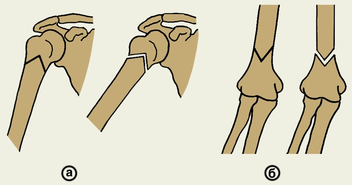 Рис. 6. Варианты остеотомии плечевой кости: а — угловая при неправильно сросшемся переломе хирургической шейки плеча; б — надмыщелковая при варусной деформации плечевой кости