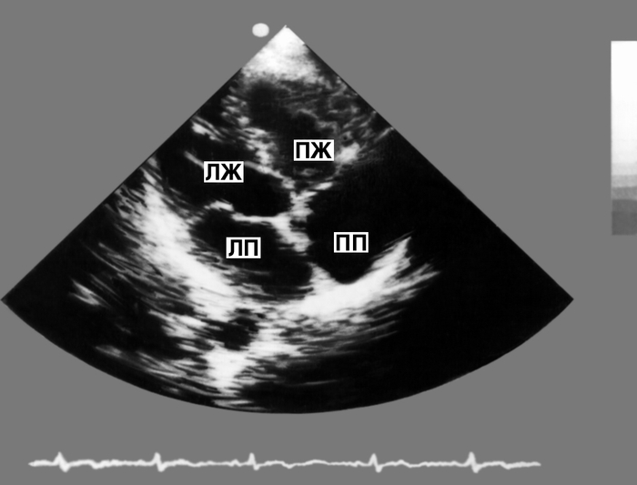 Рис. 8. Двухмерная эхокардиограмма из верхушечного доступа: видны полости всех четырех камер сердца (темные поля) в поперечном сечении, разделенные перегородками и створками атриовентрикулярных клапанов (светлые структуры)