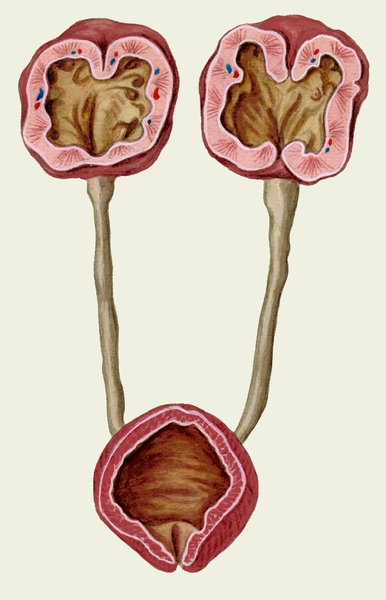 Рис. 1. Схематическое изображение почек, мочеточников и мочевого пузыря при двустороннем гидронефрозе, обусловленном аденомой предстательной железы: <a href=