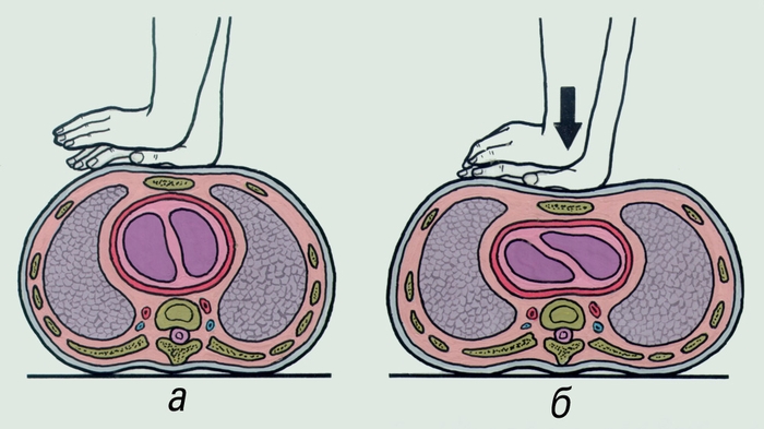 Рис. 3. Схема непрямого массажа сердца: а — наложение рук на грудину; б — нажатие нагрудину