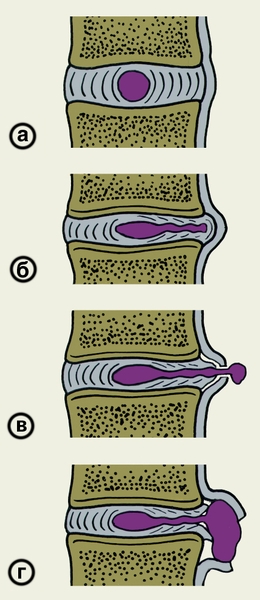 Рис. 2. Схематическое изображение грыж межпозвоночного диска: а — нормальный <a href=