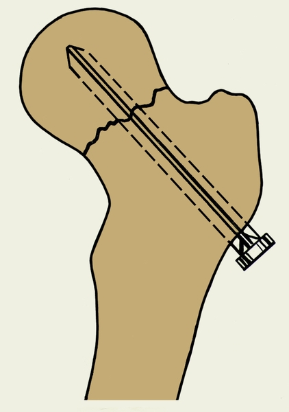 Рис. 8. Чрескостный остеосинтез шейки бедренной кости трехлопастным гвоздем