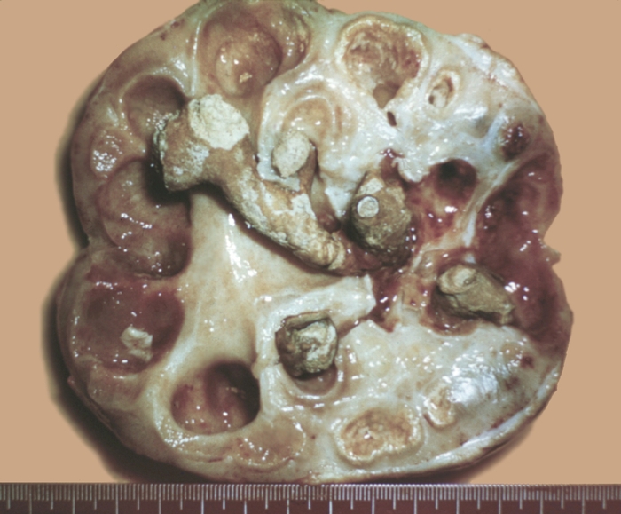 Рис. 1. Макропрепарат почки при калькулезном пиелонефрите с исходом в пионефроз: на продольном разрезе видны резко расширенные чашечки и лоханка с утолщенной склерозированной слизистой оболочкой и многочисленными различной величины мочевыми камнями; <a href=