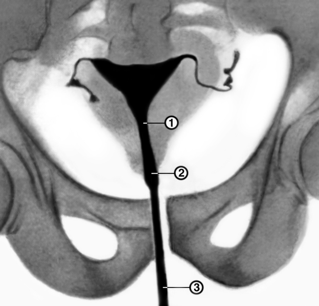 Рис. 1а). Гистерограмма в норме: 1 — перешеек матки, 2 — канал шейки матки, 3 — <a href=