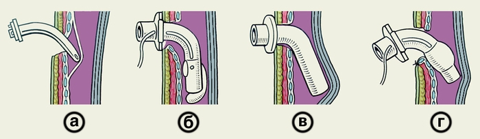 Рис. 3. Схематическое изображение некоторых осложнений трахеостомии (на сагиттальном разрезе трахеи): а — введение канюли при нерассеченной слизистой оболочке, в результате чего канюля попадает между слизистой оболочкой и хрящами трахеи; б — надувная манжета разорвана, ее конец опустился вниз и закрыл просвет канюли; в — деформация трахеи вследствие несоответствия кривизны канюли и трахеи; г — неправильное положение канюли, при котором ее нижний конец травмирует заднюю стенку трахеи