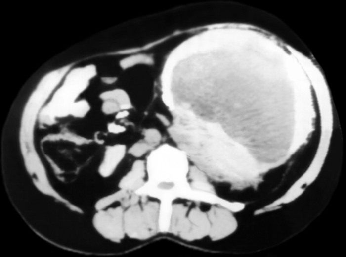 Рис. 16. Компьютерная томограмма при опухоли почки: видна больших размеров опухоль, занимающая практически всю левую половину брюшной полости