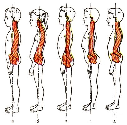 Рис. 3. Типы осанки: а — нормальная осанка; б — кифотическая осанка (круглая спина, сутулая спина); в — плоская спина; г — плосковогнутая спина; д — кифолордотическая осанка (кругловогнутая спина)
