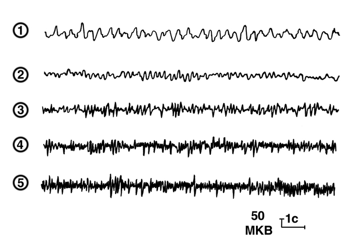 Рис. 2. Различные физиологические ритмы электроэнцефалограмм: 1 — дельта (Δ)-ритм; 2 — тета (θ)-ритм: 3 — альфа (α)-ритм, 4 — бета (β)-ритм; 5 — гамма (γ)-ритм