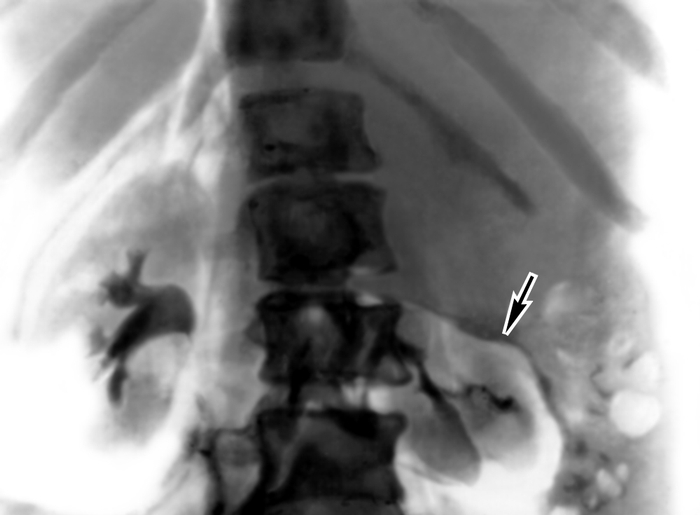 Рис. 2. Рентгенограмма забрюшинного пространства после наложения пневморетроперитонеума (в сочетании с экскреторной урографией) при липосаркоме: левая <a href=