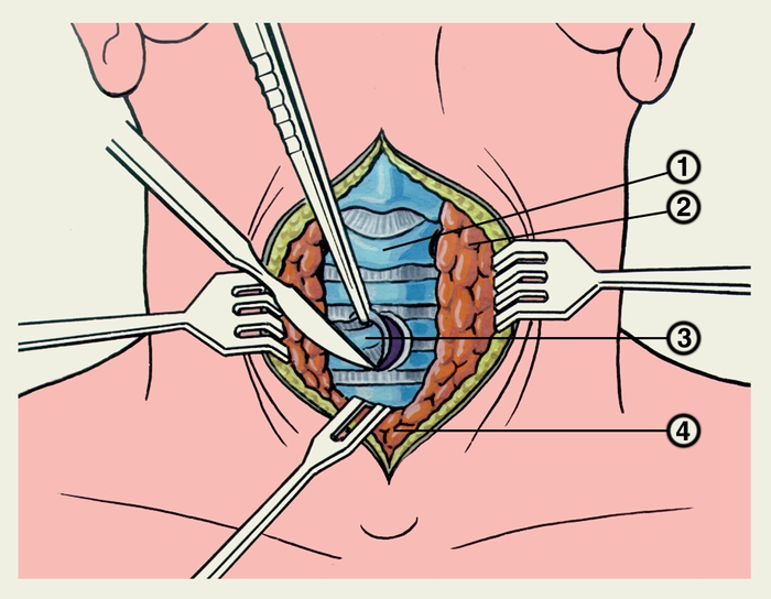 Рис. 2. Схематическое изображение формирования трахеостомического отверстия в виде круглого окна путем иссечения передней стенки трахеи: 1 — перстневидный хрящ; 2 — левая <a href=