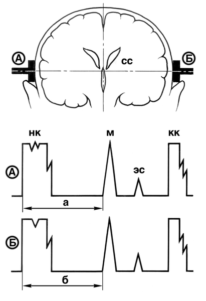 Рис. 1. Схематическое изображение эхоэнцефалограмм в норме: вверху — <a href=