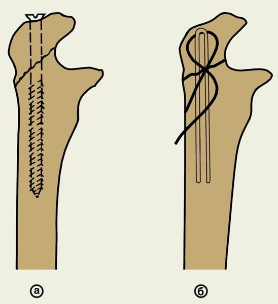 Рис. 13. Остеосинтез локтевого отростка: а — винтом; б — стягивающей проволочной петлей по Веберу